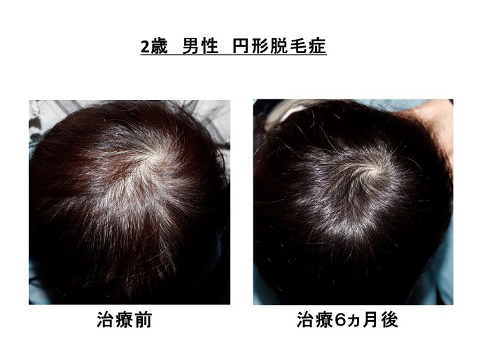 円形脱毛症　病院